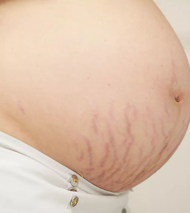 How to Remove Stretch Marks During Pregnancy?