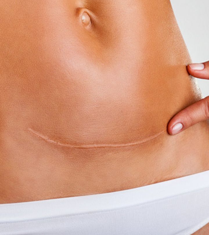 "I Wanted a Normal Delivery" — Processing the Fear and Grief Around a C-Section