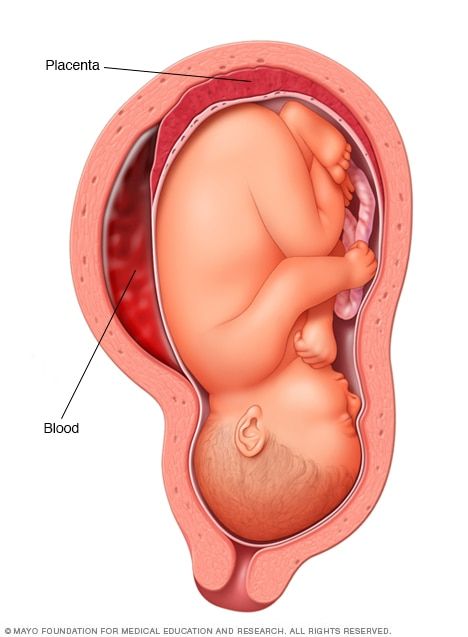 Is Anterior Placenta Normal?