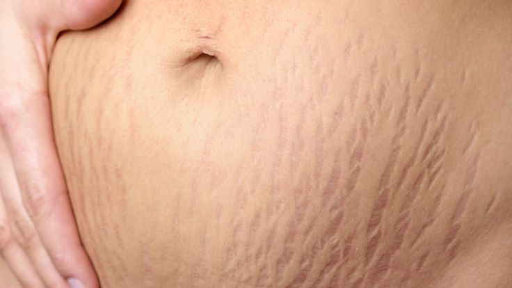 Accepting Your Body With Stretch Marks: The Change No One Really Prepares You For